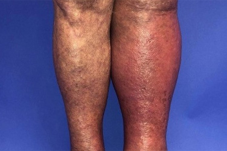 Cellulitis: How Long Does It Take to Heal on Legs?
