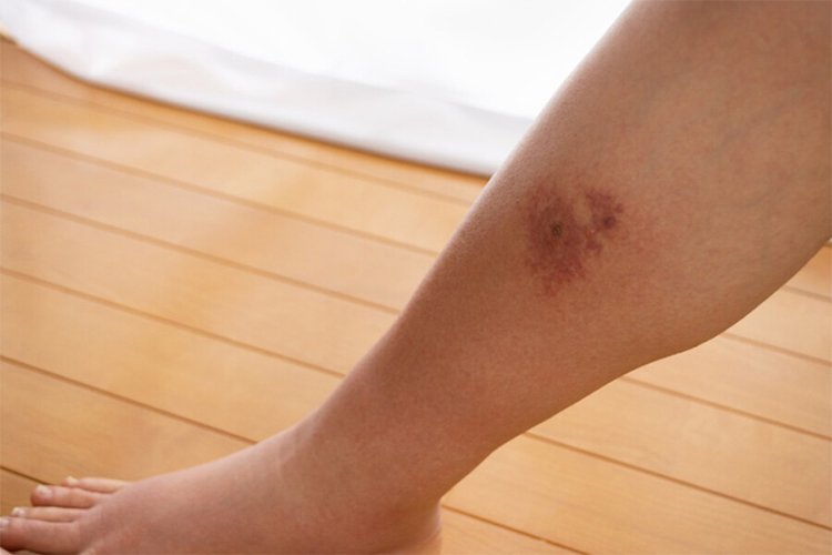 Cellulitis: How Long Does It Take to Heal on Legs?